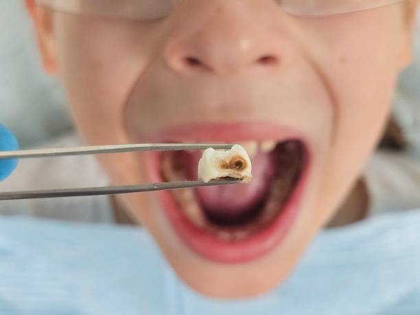 Best Emergency Wisdom Tooth Extraction in Allen, TX